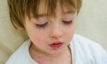 Chickenpox : Symptoms, Causes, Treatment and How to prevent