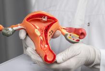 6 Things to Know About Endometriosis