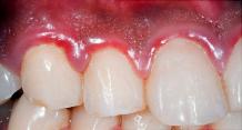 How to Cure Gingivitis? 