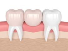  What Types Of Dental Crowns Do Cosmetic Dentistry...