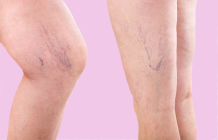 What Actually Works When You Have Vein Problems?