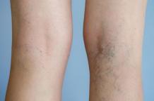 Removing Veins - Aesthetic or Health Concern?