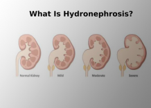 What is Hydronephrosis?