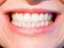 7 Benefits of Professional Teeth Whitening
