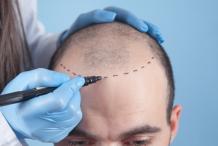 Best Hair Transplant Clinic In Delhi NCR