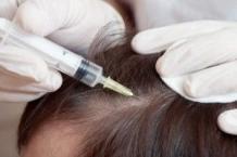 Benefits of Mesotherapy For Hair Growth