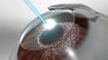 How Safe Is Cataract Surgery?