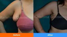  Not happy with breast shape?  Visit Karishma Cosmetic 