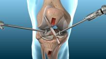 acl reconstruction surgery