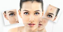 Acne Treatment in Tirupati | Laser Treatment for Acne in Tirupati