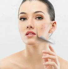 Acne Treatment Edmonton | Acne Scarring | Lucere Dermatologist