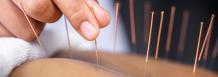 Get Relief From Various Kinds Of Pain And Discomfort With Acupuncture Therapy