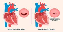 Understanding Mitral Valve Stenosis: Procedure, Benefits, and Success Rates