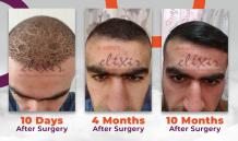 FUE Hair Transplant in Peshawar Cost 