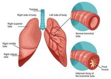 Ayurvedic Treatment for Allergic Bronchitis - Home Remedies