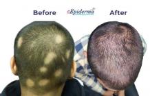 #1 Best Alopecia Areata Treatment in Durgapur