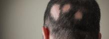 What Causes Alopecia Hair Loss? | Hair Transplant Dubai