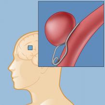 Cerebral or Brain Aneurysm Treatment in India - Healing Touristry
