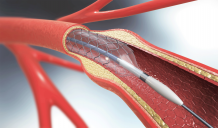 Coronary Angioplasty Stent Procedure, Angioplasty in Heart | Dr.Craghu