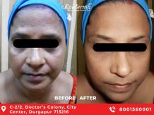 #1 Best Anti-Ageing Treatment In Durgapur