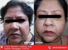 Best Anti Ageing Treatment in Asansol, Durgapur