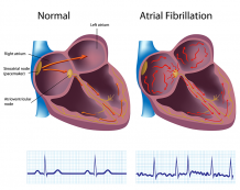 Atrial Fibrillation – Cause, Symptoms, Complications & Treatment