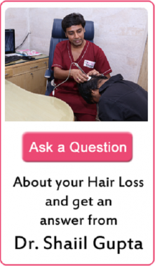 Hair loss Treatment in PitamPura - Satya Hair Clinic