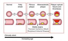 What is Coronary artery disease (CAD) - Meres 100