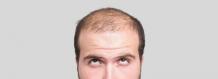 Your hair loss Questions: Answered | Hair Transplant Dubai