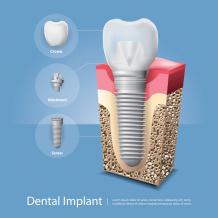 Benefits of Looking for Dental Implant Options