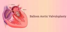 balloon aortic valvuloplasty in India