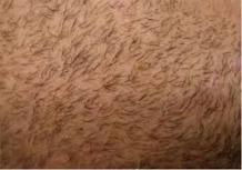 Beard Hair Transplant in Dubai, UAE | Hair Transplant Dubai