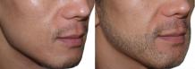 Beard Transplantation in Tirupati - Dr.Sajjas.in 