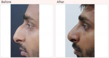 Nose Surgery in Delhi