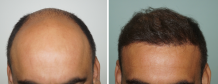  Methods of Implantation During FUE Hair Transplant