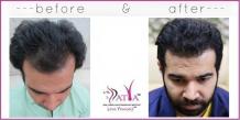 Follicular Unit Transplant - FUT Treatment in Delhi