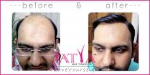 Synthetic hair transplant, Nido &amp; Biofibre hair implant in India