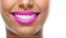 Hollywood Smile I FMS DENTAL Hospital, Hyderabad, India