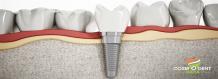 It Is Now Easier Than Ever to Have the Best Dental Implants in India