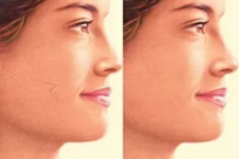 Facial Acne Scar Removal Techniques &#8211; DYNAMIC CLINIC DUBAI