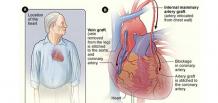 best heart bypass surgery hospital in delhi - aakash healthcare