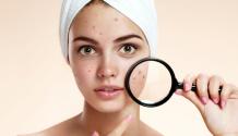 How does oxytetracycline treat acne?