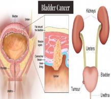 Bladder Cancer Specialist/Surgeon in Navi Mumbai