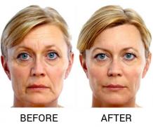 Botox Treatment | Botox Treatment Clinic Delhi | Botox Wrinkles Treatment