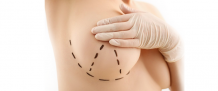  Breast Lift - Dr. Hiranmayi Jha