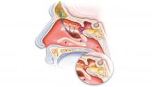 LASER works in ENT Surgery