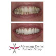 Advantage Dental Esthetic Group — How to Take Help of Internet & Local Reference to...