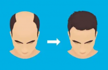 Female Hair Transplant In Delhi, India  Hair loss is a common issue that affects people of 