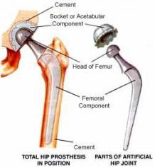  Cemented Total Hip Replacement surgery in India - Healing Touristry