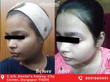 #1 Best Chemical Peeling Treatment in Durgapur